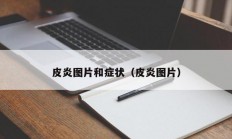 皮炎图片和症状（皮炎图片）