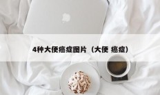 4种大便癌症图片（大便 癌症）