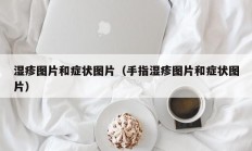 湿疹图片和症状图片（手指湿疹图片和症状图片）